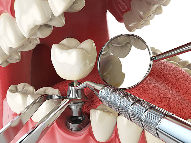 Best Emergency Dental Care for Broken or Chipped Teeth in Charlevoix, MI
